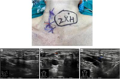 Subcutaneous Recurrences of Thyroid Cancer After Conventional Transcervical Thyroidectomy: A Case Report